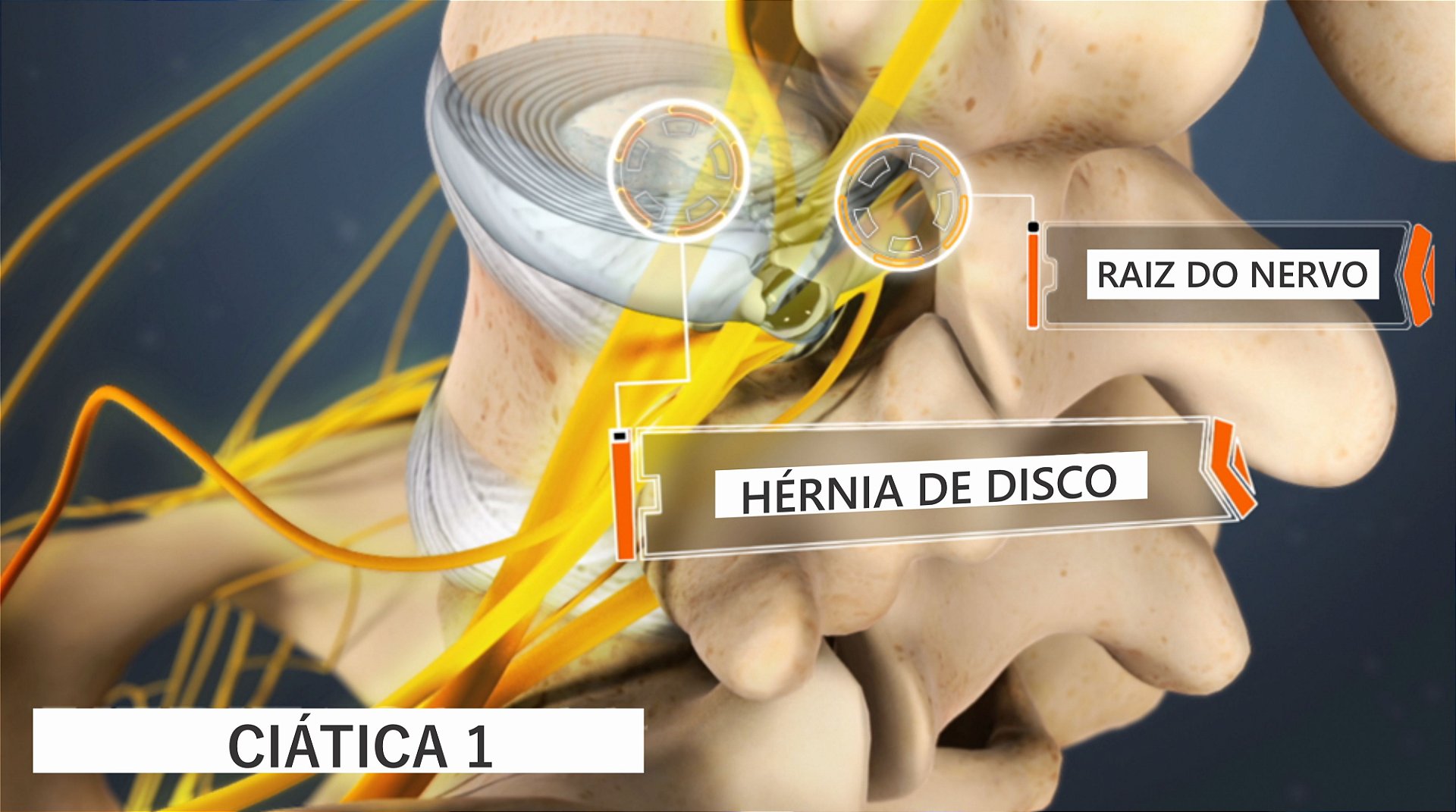 Ciática da dor determinar a como causa